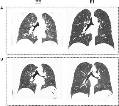 Morphometric analysis of airways in pre-COPD and mild COPD lungs using continuous surface representations of the bronchial lumen